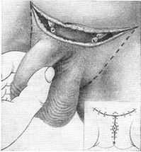 Allongement chirurgical du pénis par extraction de sa partie cachée